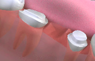 dental bridges image