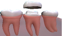 dental crowns essex