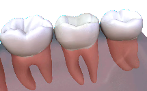 porcleain dental crowns